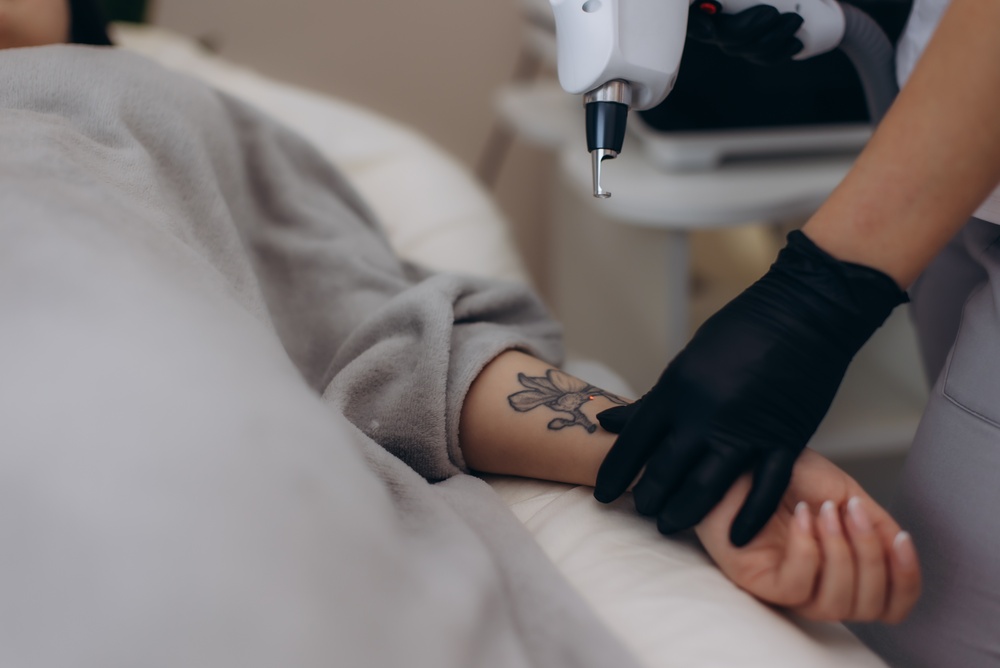 Tatoeage verwijderen met een laser op de arm